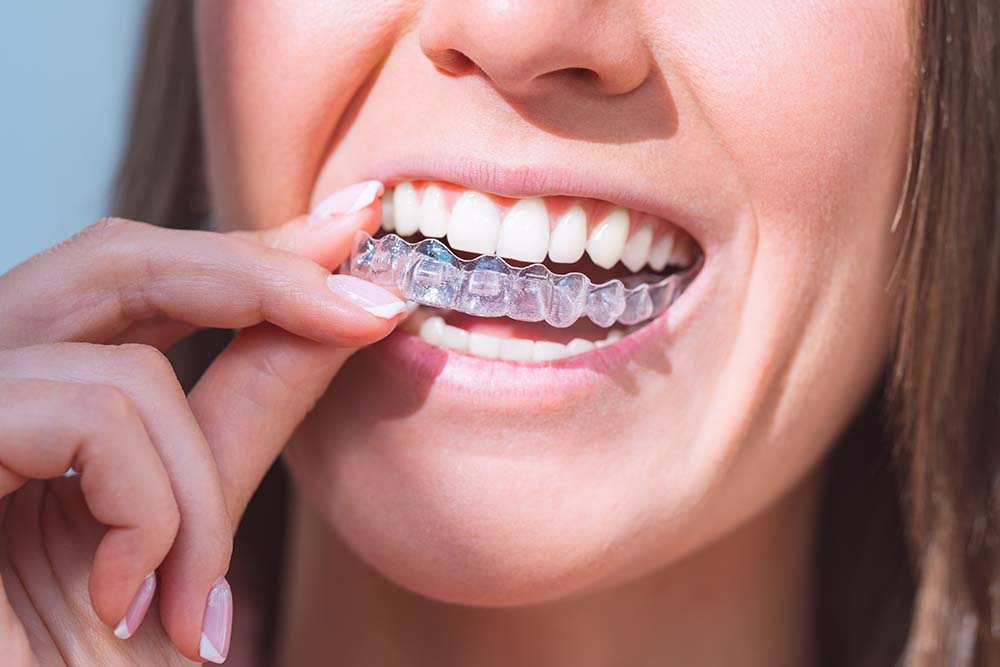 Achieve a Healthier Smile with Invisalign: The Clear Path to Dental Wellness